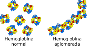 hemoglobina normal em células sanguíneas normais vermelhos e hemoglobina agregada, em forma de foice das células vermelhas do sangue